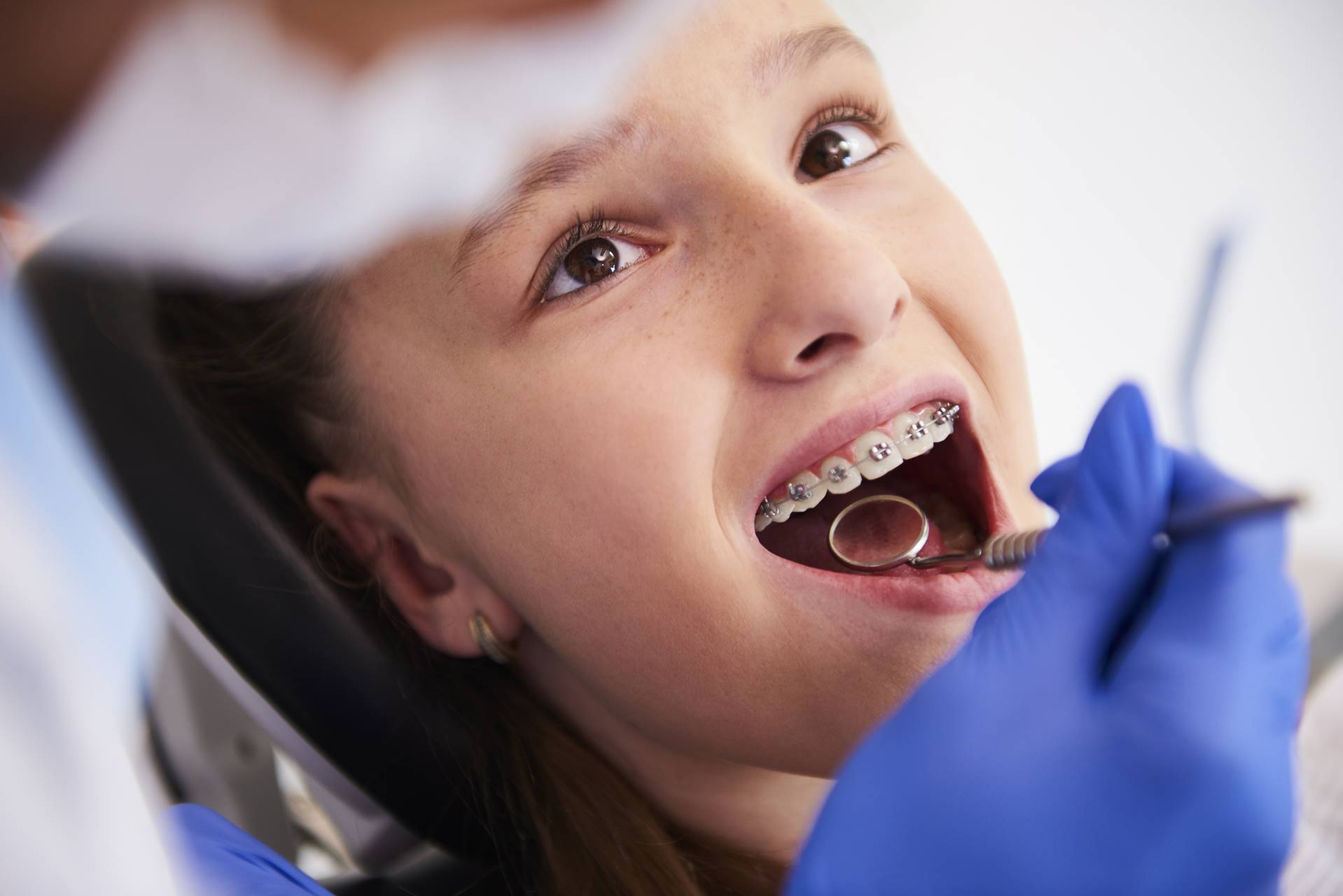 Apparecchi dentali – Quando servono e tipologie
