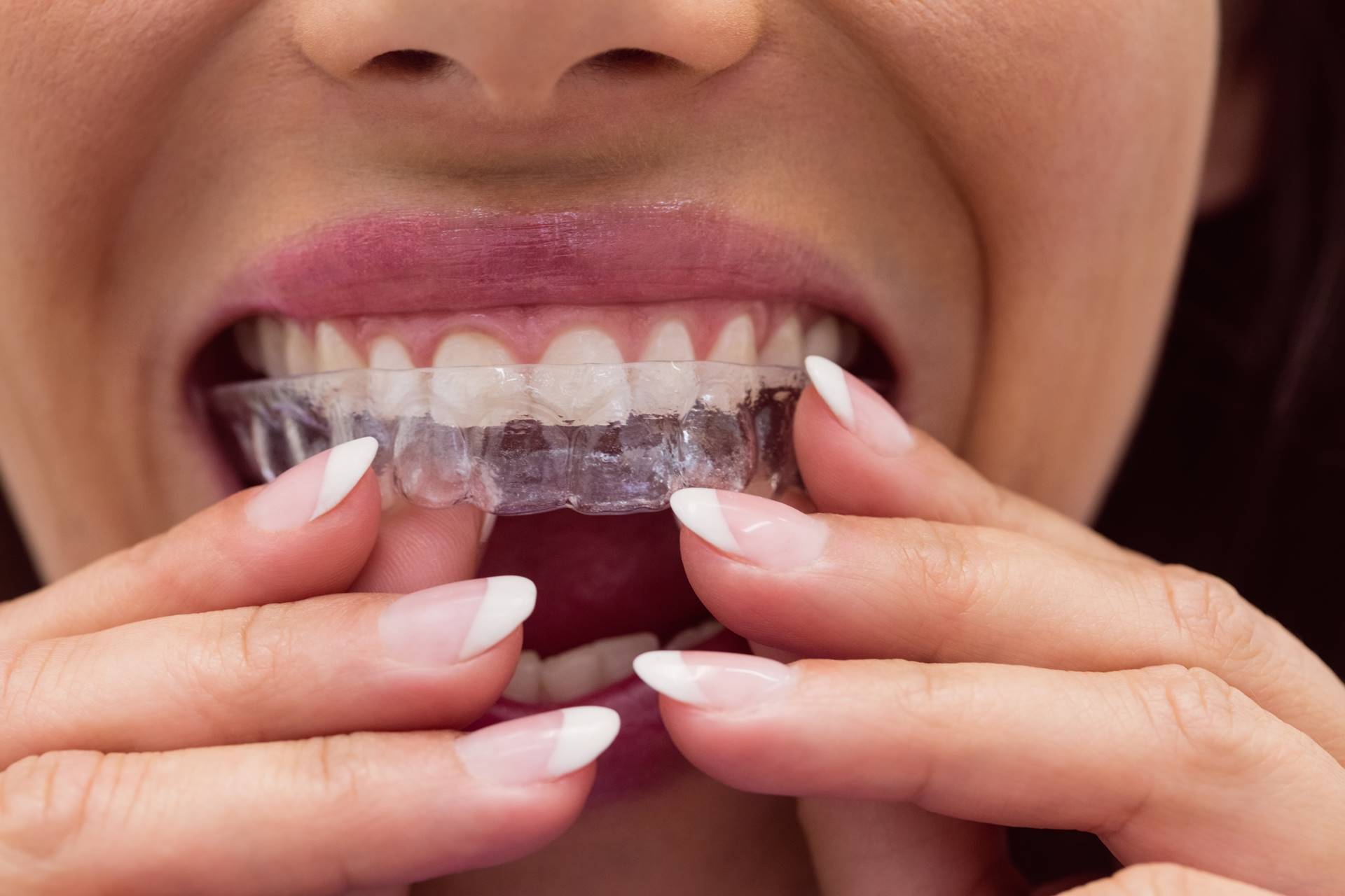 Apparecchio di contenzione – Per il mantenimento di denti perfetti